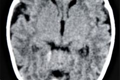 quistes-porencefalicos-hemorragia-subaracnoidea-tac-1997-007