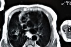 quistes-pulmonares-enfermeda-adenomatoidea-quistica-rnm-1996-000