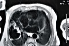 quistes-pulmonares-enfermeda-adenomatoidea-quistica-rnm-1996-001