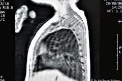 quistes-pulmonares-enfermeda-adenomatoidea-quistica-rnm-1996-002