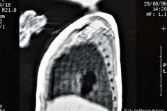 quistes-pulmonares-enfermeda-adenomatoidea-quistica-rnm-1996-006