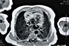 quistes-pulmonares-enfermeda-adenomatoidea-quistica-rnm-1996-010
