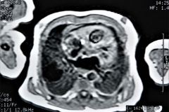 quistes-pulmonares-enfermeda-adenomatoidea-quistica-rnm-1996-016
