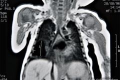 quistes-pulmonares-enfermeda-adenomatoidea-quistica-rnm-1996-019