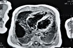 quistes-pulmonares-enfermeda-adenomatoidea-quistica-rnm-1996-022