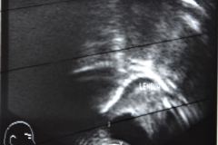 ranula-1995-002