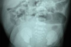 raquisquisis-t-4-hemivertebra-t-10-fusion-costal-8-9-izq-000