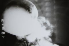 reflujo-gastroesofagico-rge-1985-000