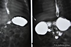 reflujo-gastroesofagico-rge-1988-002