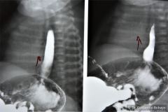 reflujo-gastroesofagico-rge-1988-004