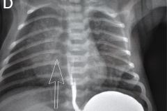 reflujo-gastroesofagico-rge-2003-001