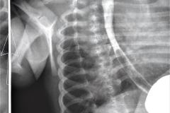 reflujo-gastroesofagico-rge-2004-001