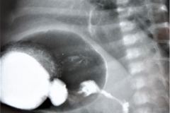 reflujo-gastroesofagico-rge-gamagrafia-positiva-2003-001