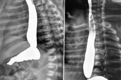 reflujo-gastroesofagico-rge-ii-2004-001