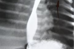 reflujo-gastroesofagico-rge-iii-1992-002