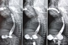 reflujo-gastroesofagico-rge-iii-2005-000