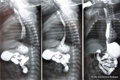reflujo-gastroesofagico-rge-iii-2005-001