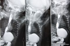 reflujo-gastroesofagico-rge-iii-2005-002