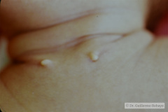 remanente-faringeo-branquial-fistula-bil-1988-000