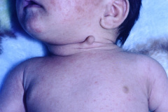 remanente-faringeo-branquial-quiste-izq-dermatitis-actinica-1997-000