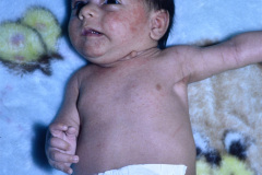 remanente-faringeo-branquial-quiste-izq-dermatitis-actinica-1997-001