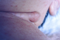 remanente-faringeo-branquial-quiste-izq-dermatitis-actinica-1997-003