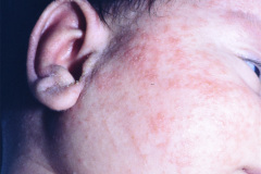 remanente-faringeo-branquial-quiste-izq-dermatitis-actinica-1997-004