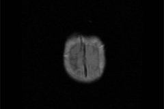 resonancia-nuclear-magnetica-rnm-serie-hidrocefalia-2007-013