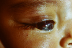 retinoblastoma-2000-004