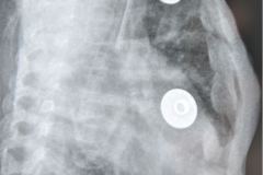 rosario-costal-osteopenia-enfermedad-osea-metabolica-eom-2005-000