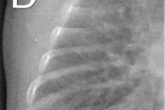 rosario-costal-osteopenia-generalizada-001