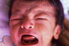 rothmund-thomson-poiquilodermia-1993-000