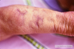 rothmund-thomson-poiquilodermia-1993-001