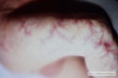 rothmunth-tompson-2000-002
