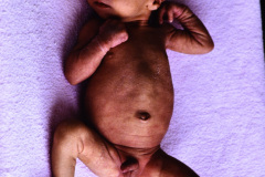 rubeola-congenita-criptorquidia-hepatoesplenomegalia-1989-002