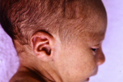 rubeola-congenita-criptorquidia-hepatoesplenomegalia-1989-003