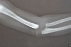 rubeola-congenita-enfermedad-radiolucida-osea-estrias-laminares-femur-1990-000