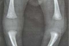 rubeola-congenita-enfermedad-radiolucida-osea-estrias-laminares-femur-1990-001