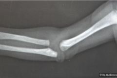rubeola-congenita-enfermedad-radiolucida-osea-estrias-laminares-femur-1990-002