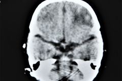 rubeola-congenita-trombocitopenia-hemorragia-intracerebral-hic-1993-000