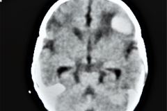 rubeola-congenita-trombocitopenia-hemorragia-intracerebral-hic-1993-001