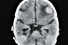 rubeola-congenita-trombocitopenia-hemorragia-intracerebral-hic-1993-002
