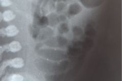 rubeola-congenita-trombocitopenia-hemorragia-intracerebral-hic-1993-003
