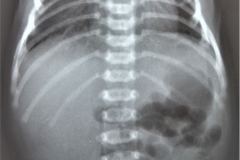 rubeola-congenita-trombocitopenia-hemorragia-intracerebral-hic-1993-004