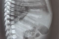 rubeola-congenita-trombocitopenia-hemorragia-intracerebral-hic-1993-005