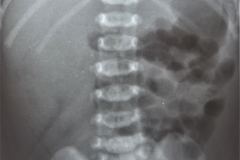 rubeola-congenita-trombocitopenia-hemorragia-intracerebral-hic-1993-006