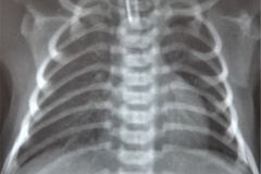 rubeola-congenita-trombocitopenia-hemorragia-intracerebral-hic-1993-007