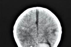 rubeola-congenita-trombocitopenia-hemorragia-intracerebral-hic-1993-008