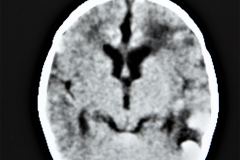 rubeola-congenita-trombocitopenia-hemorragia-intracerebral-hic-1993-009