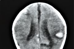 rubeola-congenita-trombocitopenia-hemorragia-intracerebral-hic-1993-010